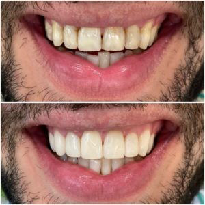 Carillas Dentales Clínica Vicálvaro Dental